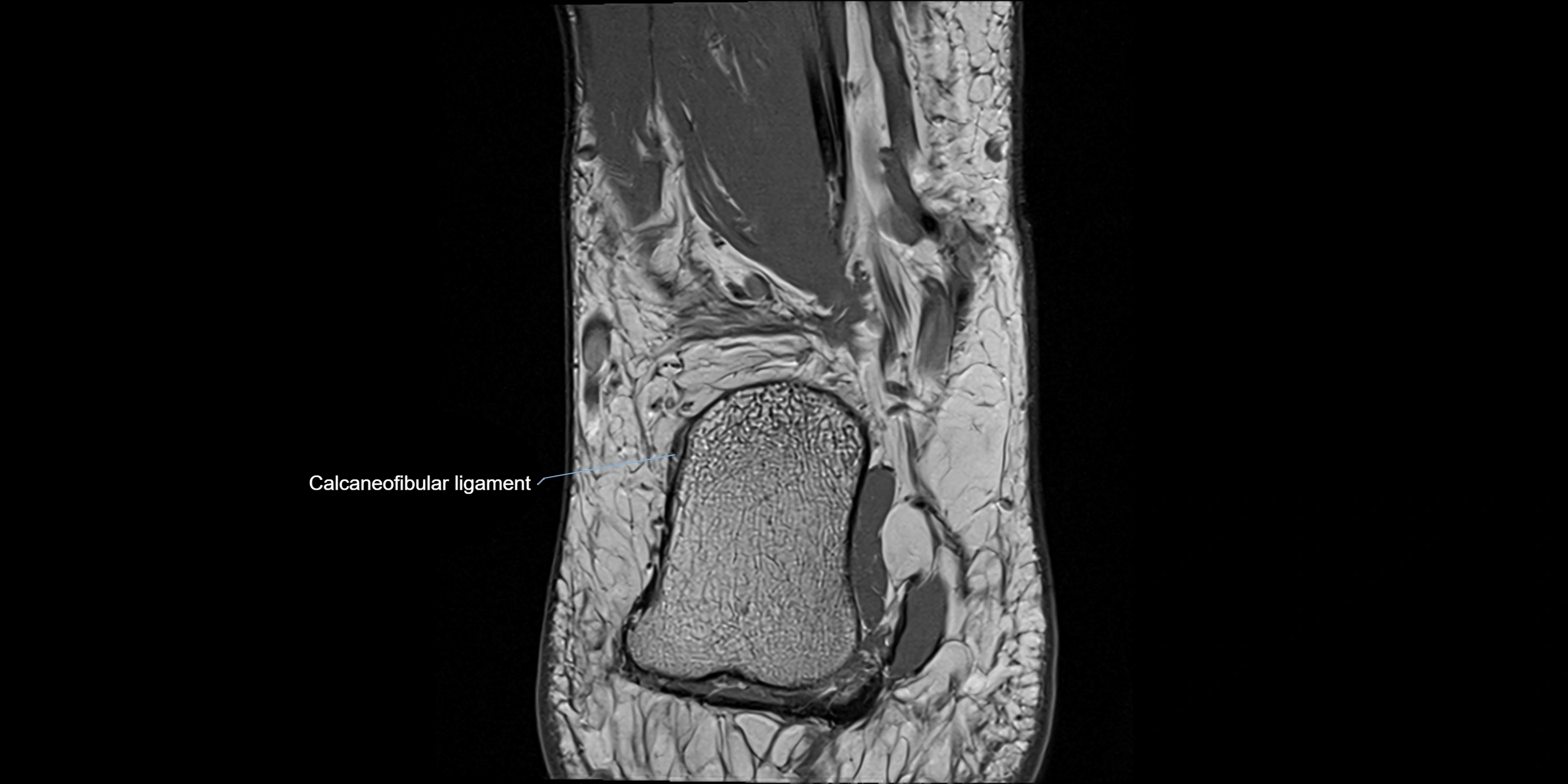 MRI Ankle coronal ligaments cross sectional anatomy 3T  radiology  image-img-00001-00022.webp
